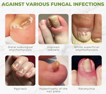 AQA  FungiVanish  Nail Treatment Oil